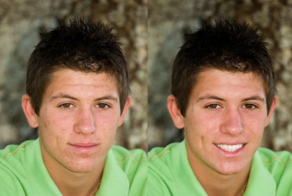 Helping Your Teen Cope With Teenage Acne 14 teen acne - before and after pictures